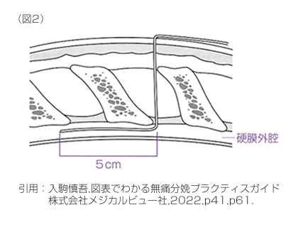 無痛分娩（硬膜外麻酔）の実際2